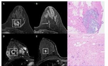 Study: MRI May Help Predict Outcomes in Treatment for Triple-Negative Breast Cancer