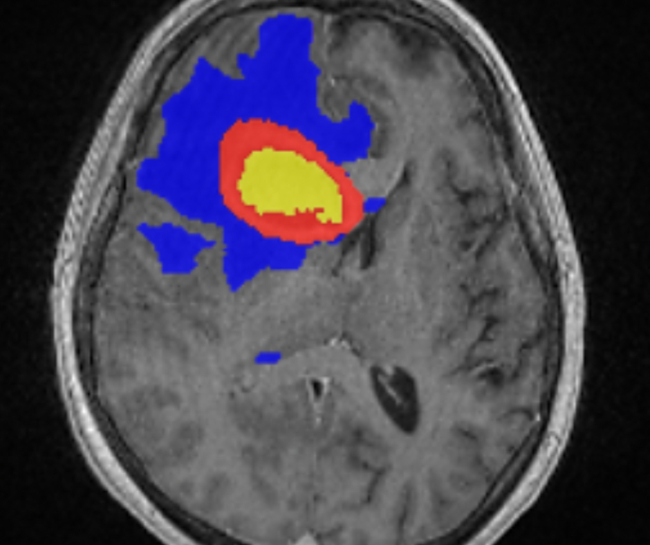 Adjunctive AI Software for Brain MRI Gets FDA Clearance for Assessing HighGrade Gliomas