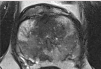 Can Pre-Op MRI Staging Help Predict Prostate Cancer Recurrence After a Prostatectomy?