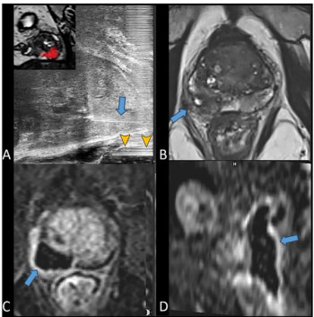 Can MRI and Micro-Ultrasound Guidance Bolster Focal Laser Ablation Outcomes for Prostate Cancer?