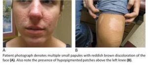 Tuberous Sclerosis Complex