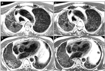 MRI Study Shows Moderate to Severe Opacities Six Months After COVID-19 Pneumonia for One-Third of Exams