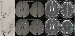 Post-Op MRI Shows New Ischemic Brain Lesions in 65 Percent of Patients After Endovascular Surgery for Intracranial Atherosclerotic Stenosis
