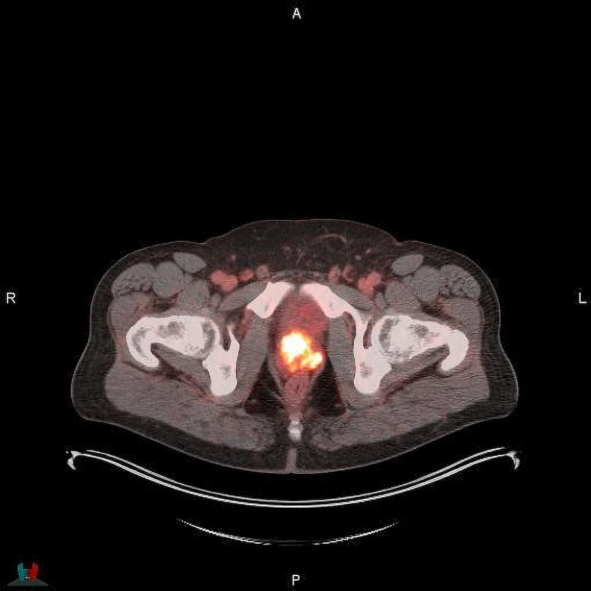 FDA Approves New PSMA PET Agent POSLUMA for Prostate Cancer Imaging