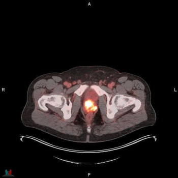 FDA Approves New PSMA PET Agent POSLUMA for Prostate Cancer Imaging