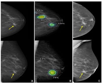 Mammography Study: Can Stand-Alone AI Enhance Detection of Interval Breast Cancer?