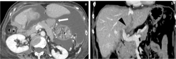 Seven Takeaways from New CT and MRI Guidelines for Ovarian Cancer Staging