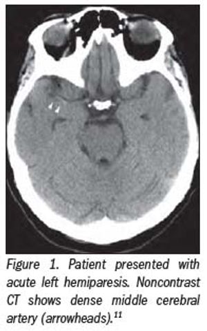 CT perfusion for stroke: Should you use it?