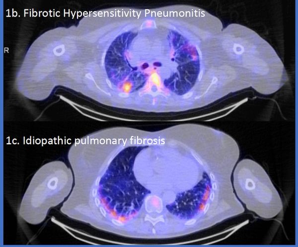 SPECT/CT Agent Garners FDA Fast Track Designation for  Inflammation Assessment in Interstitial Lung Disease