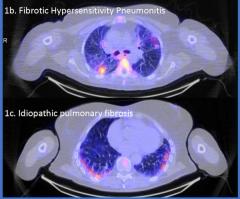 SPECT/CT Agent Garners FDA Fast Track Designation for Inflammation Assessment in Interstitial Lung Disease