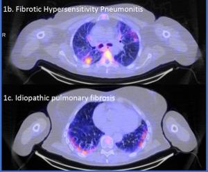 SPECT/CT Agent Garners FDA Fast Track Designation for Inflammation Assessment in Interstitial Lung Disease