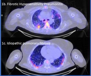 SPECT/CT Agent Garners FDA Fast Track Designation for Inflammation Assessment in Interstitial Lung Disease