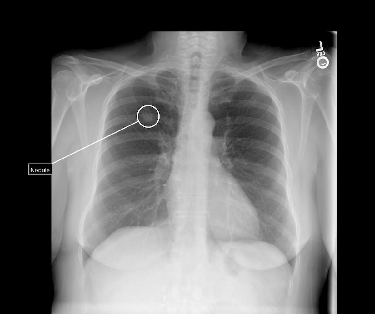 FDA Clears AI Software For Enhanced Lung Nodule Detection On Chest X-Rays