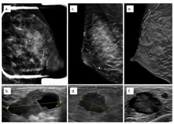 New Study Examines Impact of Mammography in Detecting Pregnancy-Associated Breast Cancer