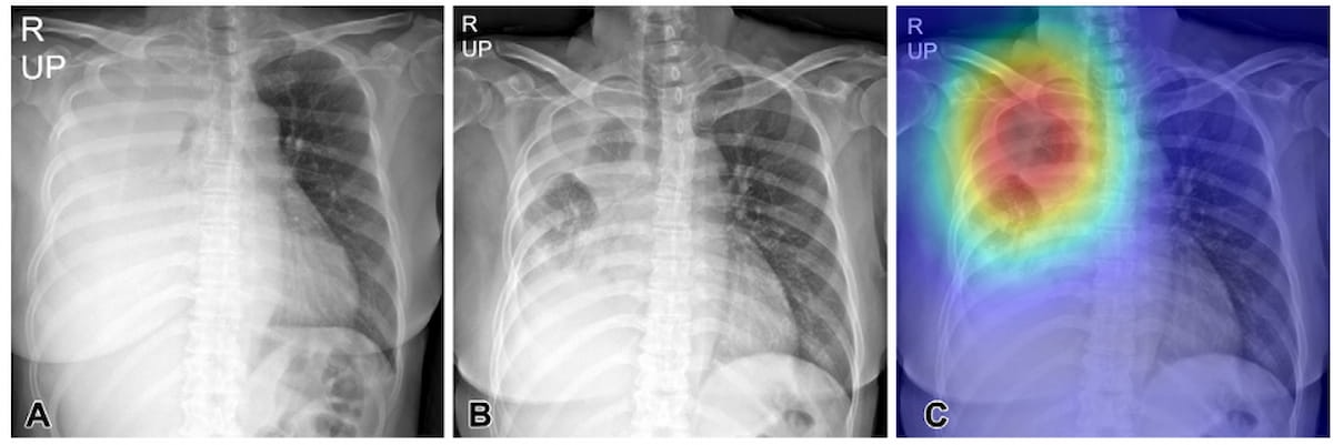 Can AI Improve Triage Efficiency in Radiology Workflows for Follow-Up X-Rays?