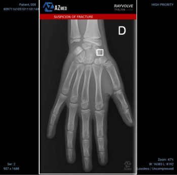 FDA Grants AI Platform Expanded Clearance for Pediatric Fracture Detection on X-Rays