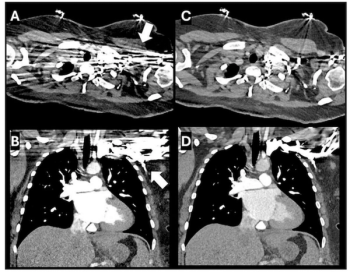 Can Polyenergetic Reconstruction Help Resolve Streak Artifacts in Photon Counting CT?