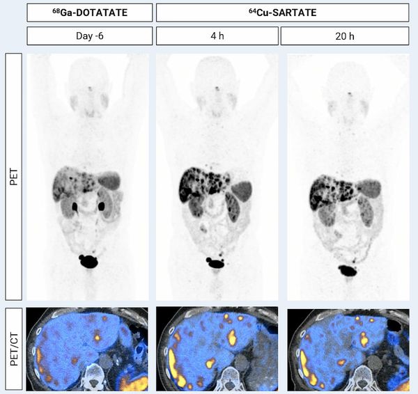 Emerging PET/CT Radiopharmaceutical May Double Detection of Liver Foci in Patients with Neuroendocrine Tumors 