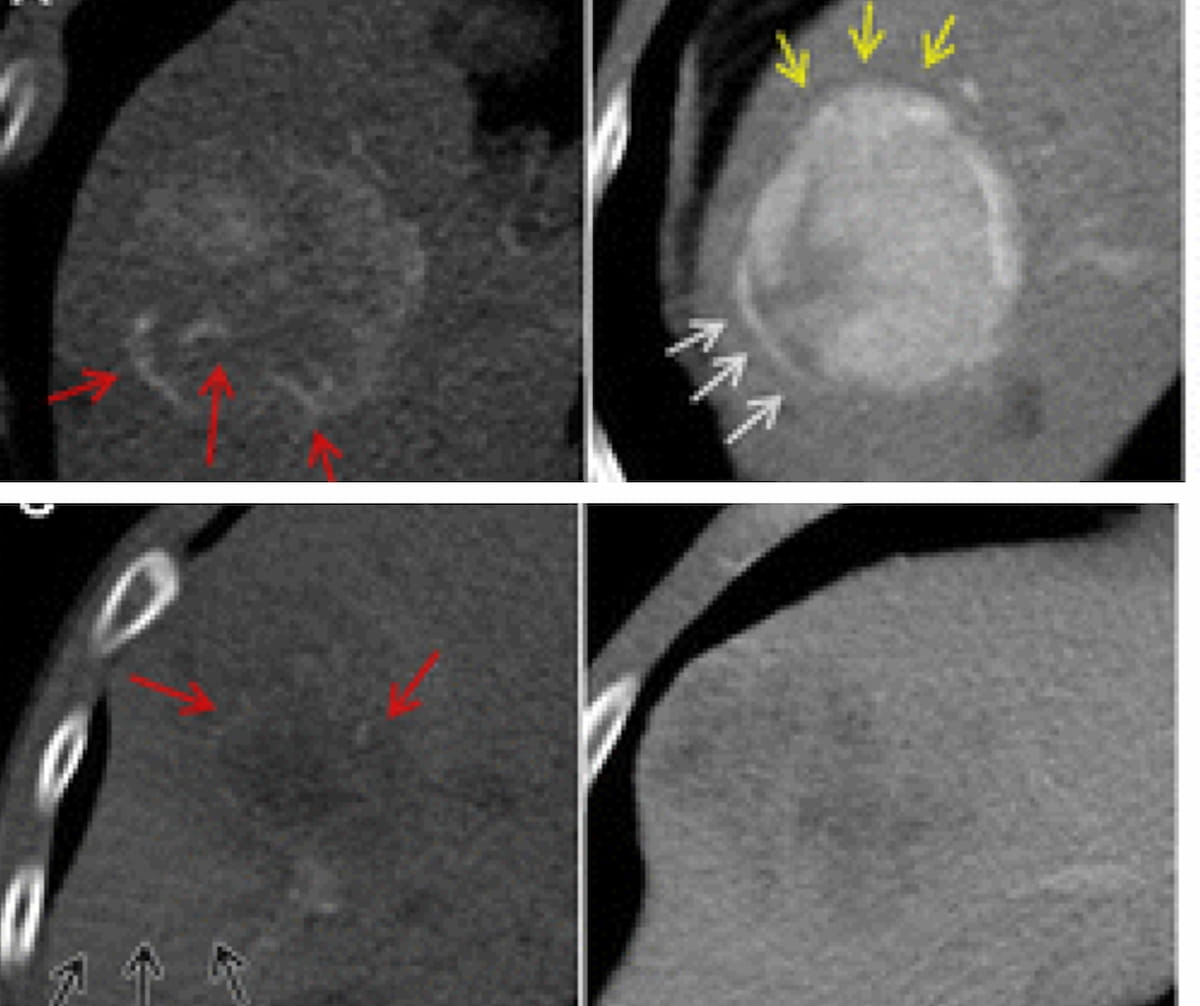 Microvascular Invasion in Hepatocellular Carcinoma: Can a CT Radiomics Model Have an Impact?