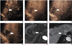 Could Contrast-Enhanced Ultrasound with Perfluorobutane Provide a Viable Option for Diagnosing Hepatocellular Carcinoma?