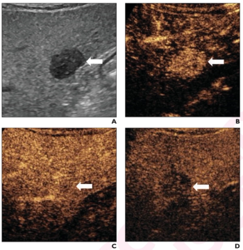 Seven Takeaways from New Literature Review on Ultrasound and Hepatocellular Carcinoma