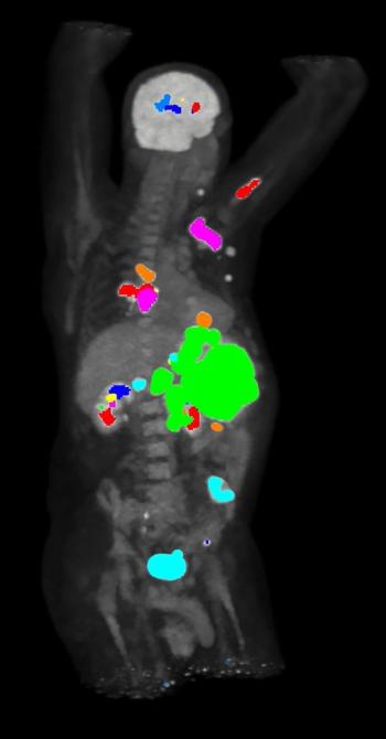 FDA Clears Automated Segmentation and Quantification Tool for PET Scans