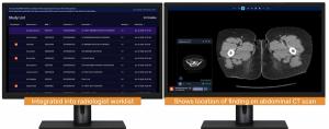 CT Triage Software Garners NTAP Reimbursement from CMS for Inpatient Medicare Beneficiaries