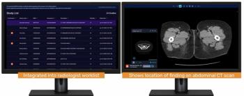 CT Triage Software Garners NTAP Reimbursement from CMS for Inpatient Medicare Beneficiaries
