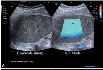 Can Multiparametric Ultrasound Enhance Detection of Metabolic Dysfunction-Associated Steatohepatitis (MASH)?