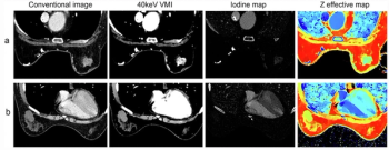 Can a Dual-Energy CT Model Bolster Breast Cancer Detection?