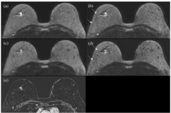 Breast MRI Study Reveals 29 Percent Reduction in Scan Time with Deep Learning Reconstruction and Multi-Shot DWI