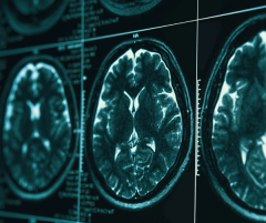FDA Clears MRI-Based AI Software for Prognostic Evaluation of Patients with Mild Cognitive Impairment
