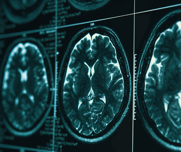 Brain MRI Study Reveals Higher Brain Age Gap and White Matter Hyperintensity for Those in Disadvantaged Neighborhoods
