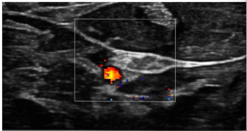 Cadwell Industries Launch Neuromuscular Ultrasound Device
