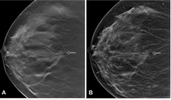 Digital Breast Tomosynthesis and Breast Density: What a New Study Reveals