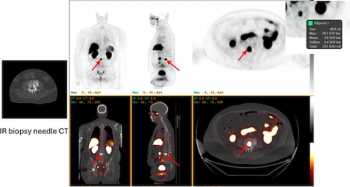 Study Shows No Impact of Hormone Therapy on PET/CT with 18F-Piflufolastat in PCa Imaging