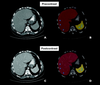 FDA Clears AI Software for Liver Attenuation on Abdominal CT
