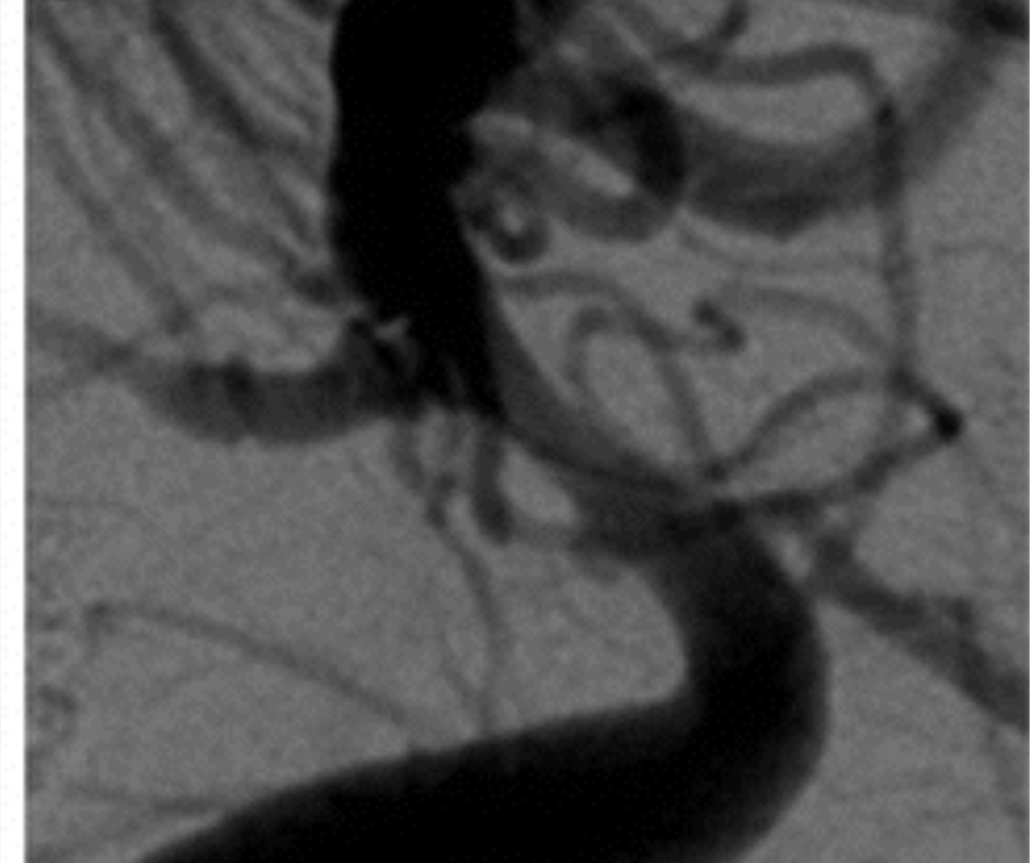 Multicenter Study Assesses Intrasaccular Flow Disruption for Treating Sidewall Aneurysms