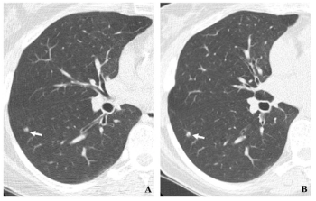 Researchers Cite 81 Percent Survival Rate 20 Years After Initial Lung Cancer Diagnosis with Low-Dose CT