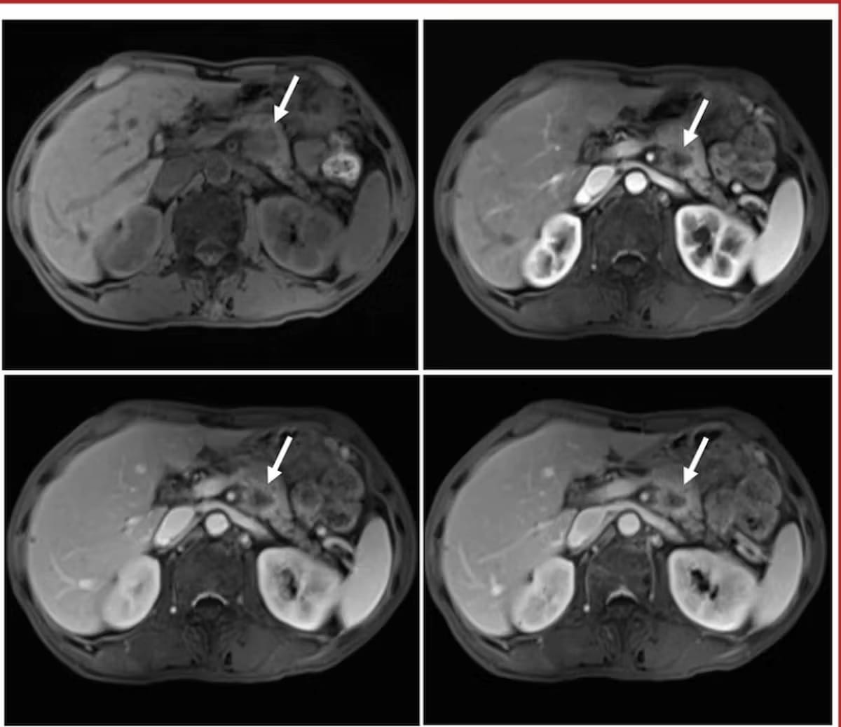 MRI, CT or Ultrasound: Which Modality Offers the Most Utility for Imaging of Pancreatic Cancer?