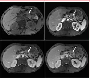 MRI, CT or Ultrasound: Which Modality Offers the Most Utility for Imaging of Pancreatic Cancer?