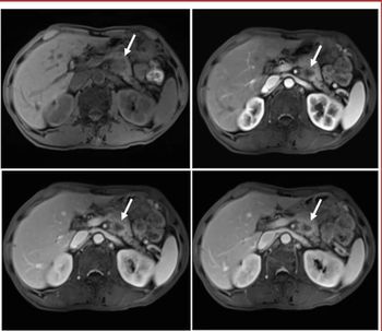 MRI, CT or Ultrasound: Which Modality Offers the Most Utility for Imaging of Pancreatic Cancer?