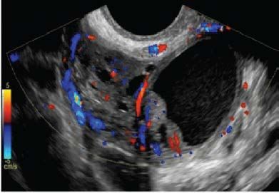 Key Challenges with the O-RADS Ultrasound Classification System