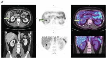 Study for Emerging PET/CT Agent Reveals ‘New Standard’ for Detecting Clear Cell Renal Cell Carcinoma