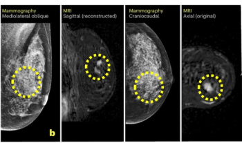Can AI Facilitate Effective Triage for Supplemental Breast MRI After Negative Mammography Screening?