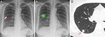 Study Shows Benefits of AI in Detecting Lung Cancer Risk in Non-Smokers