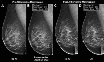 Mammography Study Shows Key Findings with AI in DBT Screening