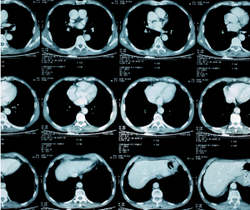 Study Examines Use of Lung-RADS Categories on Follow-up CT Screening