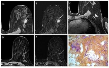 Assessing Post-Treatment MRI for Predicting Neoadjuvant Chemoimmunotherapy Response for Triple-Negative Breast Cancer