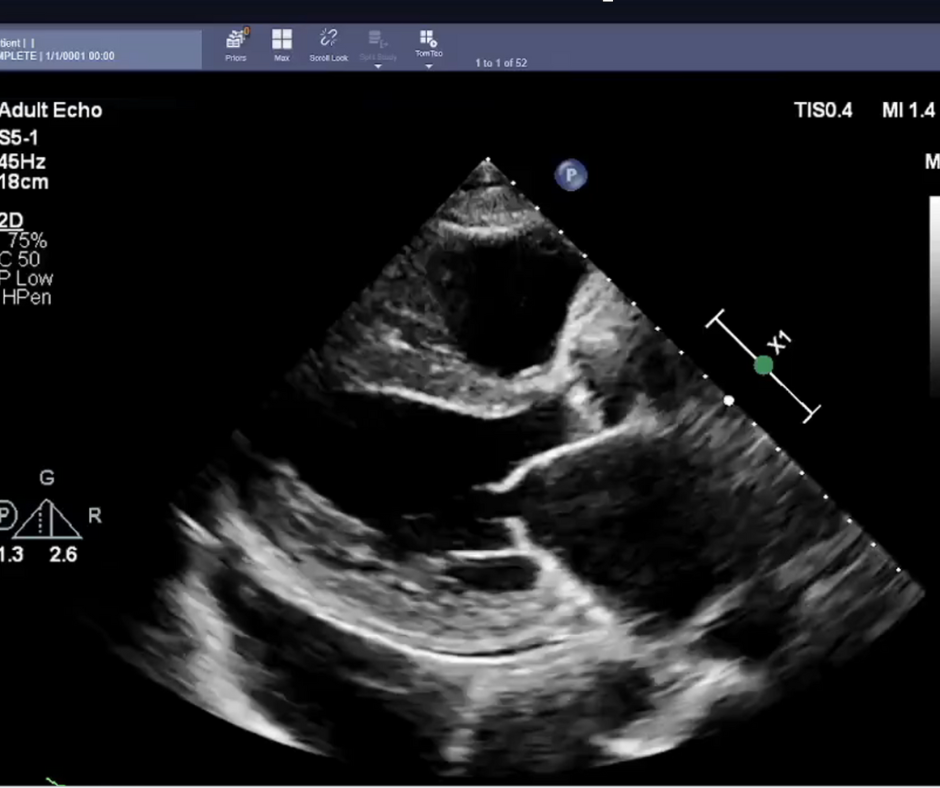 Study Suggests AI is Superior to Sonographer Assessment of Heart Function on Echocardiograms